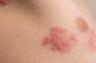 Shingles Pictures Don’t Simply Stop Ache—They Would possibly Save Your Life